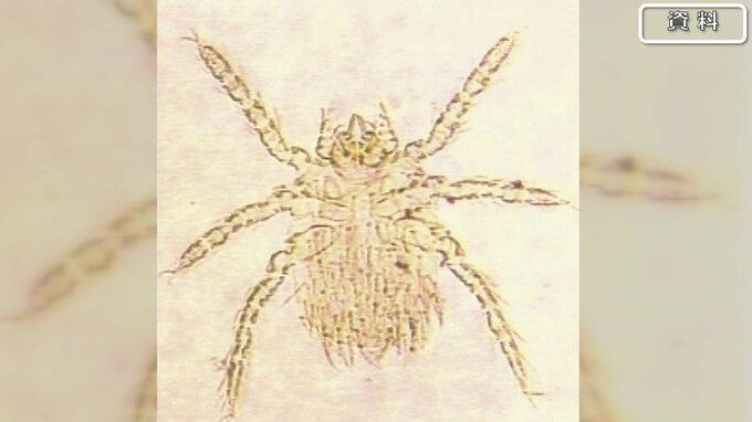県内で今年初「つつが虫病」患者発生　ダニの一種「ツツガムシ」による感染症　県は対策を呼び掛け|TBS NEWS DIG
