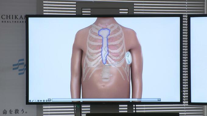 「不整脈」による突然死防げ！高知県内初・最新医療機器「EV－ICD」を患者の体に埋め込む手術を実施　|　高知のニュース・天気｜KUTV NEWS | KUTVテレビ高知