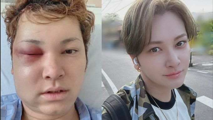 【 10万人に1人の難病・間瀬翔太 】　40歳迎えた想い綴る　「生きるってめちゃくちゃ難しいけど、本当に幸せ」「無事に41歳になれます様に」 【 脳動静脈奇形 】|TBS NEWS DIG