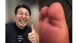 痛風で足の指がパンパンに…レインボー・ジャンボたかおさん　「親指デカっ！！！！！！！！」　ファン「痛そう」|TBS NEWS DIG