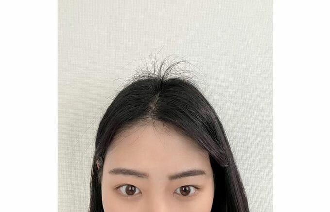 高安奈緒子さん　「産後抜けた毛たちが元気に」　出産後、抜け毛に悩んだ髪が、元気に生えてきた様子を報告|TBS NEWS DIG