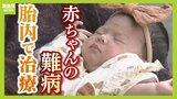 【赤ちゃんの難病】「手術受けて本当に良かった」母親のおなかの中で「手術」国内初の治療法とは？「脊髄髄膜瘤」の新たな選択肢、患者の希望の光になるか|TBS NEWS DIG
