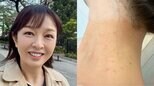 【 丸岡いずみ 】　人生初の毛虫被害で皮膚炎に　「こんなに痒いのね」　GWのキャンプや露天風呂が原因か|TBS NEWS DIG