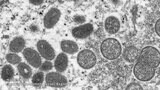日本国内で初めて感染確認「サル痘」とは?症状は?対策は? サル痘に詳しい岡山理科大学・森川茂教授が徹底解説|TBS NEWS DIG
