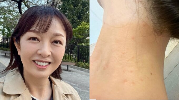 【 丸岡いずみ 】　人生初の毛虫被害で皮膚炎に　「こんなに痒いのね」　GWのキャンプや露天風呂が原因か|TBS NEWS DIG