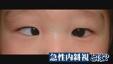 子どもや若者の「急性内斜視」が問題に 元に戻らなくなり、手術が必要となるケースも|TBS NEWS DIG