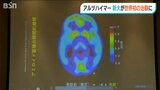 「30代から50代での発症多い」遺伝性アルツハイマー病 世界初の治験に新潟大学が参加|TBS NEWS DIG