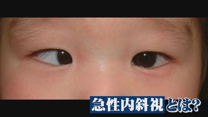 子どもや若者の「急性内斜視」が問題に　元に戻らなくなり、手術が必要となるケースも　|　BSSニュース | BSS山陰放送