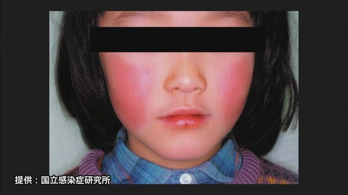 「リンゴ病」5年ぶりの流行拡大　全国の患者数が2週ぶりの増加　関東1都3県で“警報レベル”　妊婦は胎児に影響する場合もあり注意が必要|TBS NEWS DIG