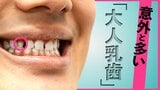 大人になっても乳歯のまま…その割合「10人に1人」 生え変わるはずの永久歯がない「大人乳歯」の対処法|TBS NEWS DIG
