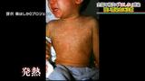 1人が最大18人にうつす強い感染力を持つ「はしか」 乳幼児では重症化や死亡する例も 予防に大切なことは | 沖縄のニュース|RBC 琉球放送