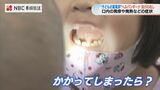 例年より早い流行の兆し 子どもの夏風邪の一種『ヘルパンギーナ』症状や対策など小児科医に聞きました | 長崎のニュース | 天気 | NBC長崎放送