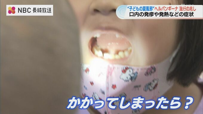例年より早い流行の兆し 子どもの夏風邪の一種『ヘルパンギーナ』症状や対策など小児科医に聞きました　|　長崎のニュース | 天気 | NBC長崎放送