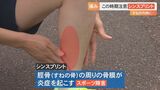 「すねの内側が痛い」運動部の新入生、この時期多い…スポーツ障害「シンスプリント」とは？　|　BSSニュース | BSS山陰放送