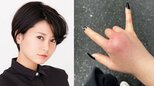 【 RaMu 】　ペットに噛まれ「蜂窩織炎」に　３８度超えの高熱も　「1週間2種類の点滴生活を強いられている」「指動かないしめちゃ激痛」|TBS NEWS DIG