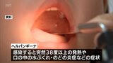 乳幼児を中心に流行する夏風邪「ヘルパンギーナ」　宮崎県内で今季初の「流行警報レベル」に　手洗いやうがいなどの対策を　|　MRTニュース ｜ ＭＲＴ宮崎放送