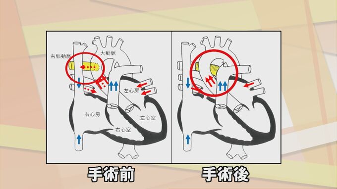 世界初の手術に成功…極めて珍しい症例「右肺動脈大動脈起始症」に「右肺動静脈瘻」「高度肺高血圧」を合併　島根大学医学部附属病院|TBS NEWS DIG