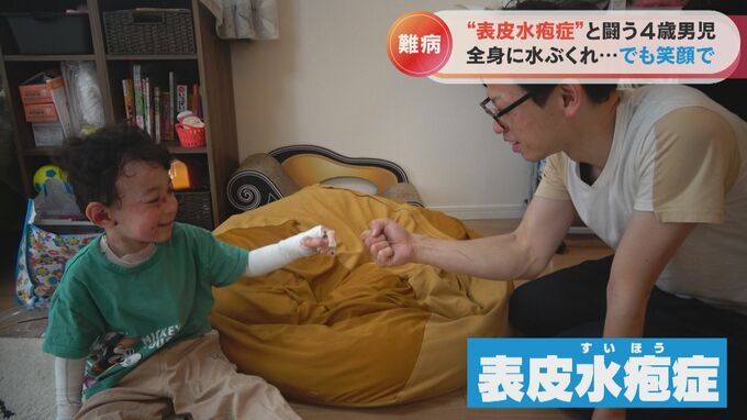 激痛を伴う水ぶくれが全身に…　全国でわずか1000人の難病「表皮水疱症」と闘う4歳の男の子の日常　|　名古屋・愛知・岐阜・三重のニュース【CBC news】 | CBC web