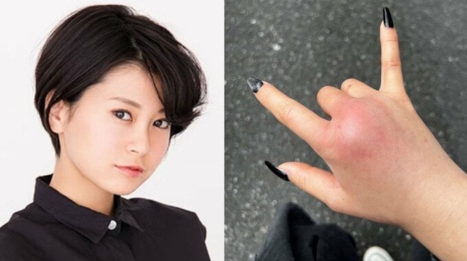【 RaMu 】　ペットに噛まれ「蜂窩織炎」に　３８度超えの高熱も　「1週間2種類の点滴生活を強いられている」「指動かないしめちゃ激痛」|TBS NEWS DIG