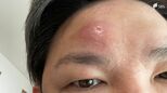 「一生に一度だけ?」「体を一周したら…死⁉」“帯状疱疹”気になるウワサを“経験記者”が調べてみた|TBS NEWS DIG