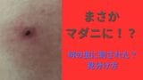 虫刺されの痕に「血豆」...これってもしや“マダニ”!?何の虫に刺されたのか「見分ける方法」「適切な処置」教えます【画像閲覧注意!】|TBS NEWS DIG