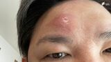 「一生に一度だけ?」「体を一周したら…死⁉」“帯状疱疹”気になるウワサを“経験記者”が調べてみた | 静岡のニュース | SBSNEWS | 静岡放送