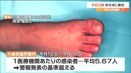 手到病自除 口の中などに2～3ミリの発疹「手足口病」増加で宮城県が警報