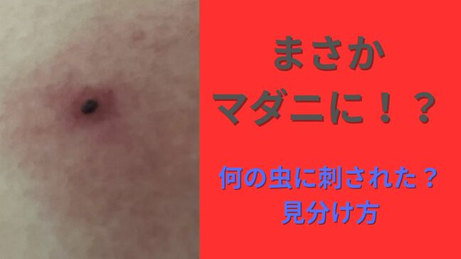 虫刺されの痕に「血豆」...これってもしや“マダニ”！？何の虫に刺されたのか「見分ける方法」「適切な処置」教えます【画像閲覧注意！】|TBS NEWS DIG