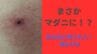 虫刺されの痕に「血豆」...これってもしや“マダニ”！？何の虫に刺されたのか「見分ける方法」「適切な処置」教えます【画像閲覧注意！】　|　岡山・香川のニュース | 天気 | RSK山陽放送