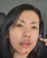 【 小島可奈子 】 顔面を犬に「噛まれました」 4針ほど縫うケガ 痛々しい傷跡の動画公開 |TBS NEWS DIG