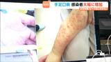 手足口病が流行 小児科医「これから加速度的に増えるのでは」感染経路は飛沫や接触などでおむつ交換時にも注意が必要 宮城|TBS NEWS DIG