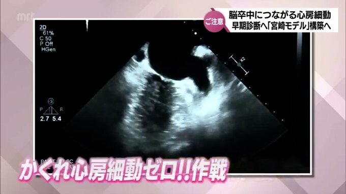 「不整脈が脳卒中の原因に」モニター心電図を全国に先駆けて集団検診の会場に導入を　 目指せ！「かくれ心房細動」ゼロ！　|　MRTニュース ｜ ＭＲＴ宮崎放送