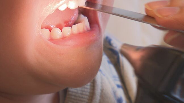 インフルエンザ流行期が例年より早く到来　患者数1.9倍に増加　早めのワクチン接種呼びかけ　大分|TBS NEWS DIG