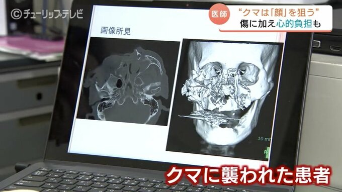“軽傷であっても命に関わる可能性”医師が語るクマ被害の実態  顔面骨折と破傷風の脅威 遭遇時は“顔と頭を守る”　|　富山のニュース｜天気・防災｜チューリップテレビ