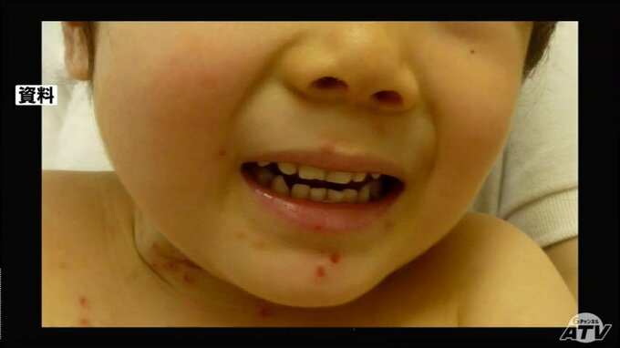 青森県内の4つの管内で「手足口病」の警報発表　2022年11月以来・約1年8か月ぶり　|　青森のニュース│ATV NEWS│青森テレビ