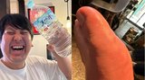 【痛風】レインボーのジャンボたかおさん「痛ってえ〜！」水ボトルを掲げて苦笑「腫れ過ぎてもはや艶」|TBS NEWS DIG