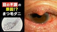 顔の毛穴に寄生し皮脂を食べる「ダニ」… 増殖すると眼瞼炎やドライアイなどの原因にも まつ毛エクステやアイメイクをしている人は要注意【まつ毛ダニ】 | 富山のニュース|天気・防災|チューリップテレビ