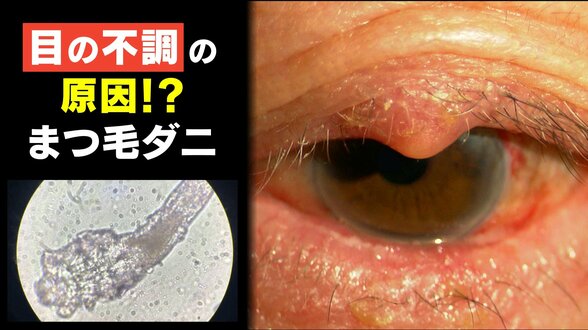 顔の毛穴に寄生し皮脂を食べる「ダニ」… 増殖すると眼瞼炎やドライアイなどの原因にも まつ毛エクステやアイメイクをしている人は要注意【まつ毛ダニ】　|　富山のニュース｜天気・防災｜チューリップテレビ