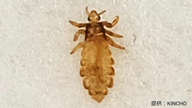 髪の毛の“白いモノ”「フケではなく卵かも」コロナ明けから再び増加傾向のシラミ 見分け方は？かゆくなった時には既にたくさんのタマゴが…?|TBS NEWS DIG