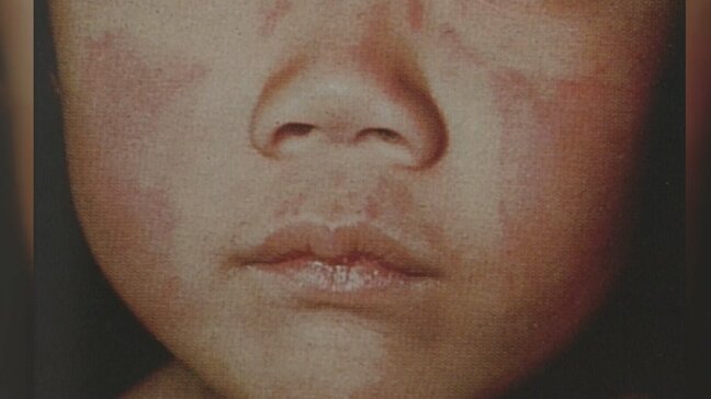 「りんご病」患者の増加続く…6週連続で“警報レベル”超　1定点あたり4.57人　富山|TBS NEWS DIG