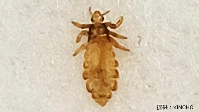 髪の毛の“白いモノ”「フケではなく卵かも」コロナ明けから再び増加傾向のシラミ 見分け方は？かゆくなった時には既にたくさんのタマゴが…?|TBS NEWS DIG