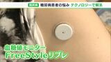 「バチンとやるのが毎回いや」針を刺さなくても大丈夫 糖尿病患者の悩みをテクノロジーで解消|TBS NEWS DIG
