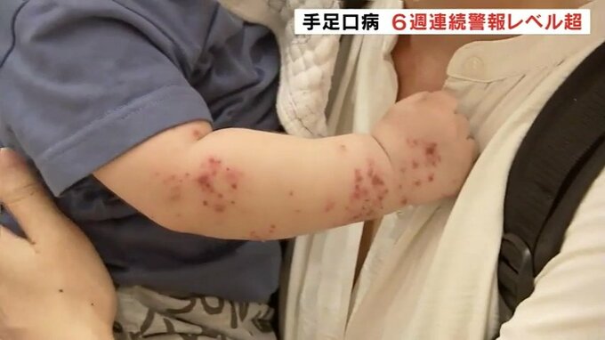 6週連続で警報レベルをはるかに超える手足口病の流行 手洗いの徹底など感染予防を呼び掛け　|　富山のニュース｜天気・防災｜チューリップテレビ