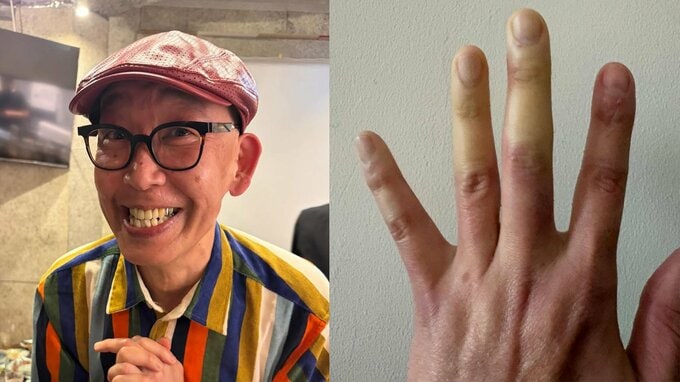 【 坂本ちゃん 】　指先の「激しい変色」で困惑　「きゃー！やだー！」「指先冷えてたいへーん！」　ファンからは「今すぐ病院行って」と心配の声|TBS NEWS DIG