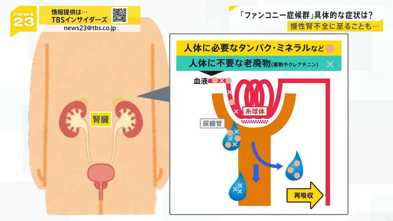 “紅麹サプリ”大半の患者が「ファンコニー症候群」か、具体的な症状は? 4分の3ほどは服用中止で症状改善「必要以上に怖がらず、不調があれば受診を