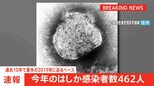 【速報】今年のはしか感染者数462人 過去10年で最多だった2019年に迫るペース 厚生労働省|TBS NEWS DIG