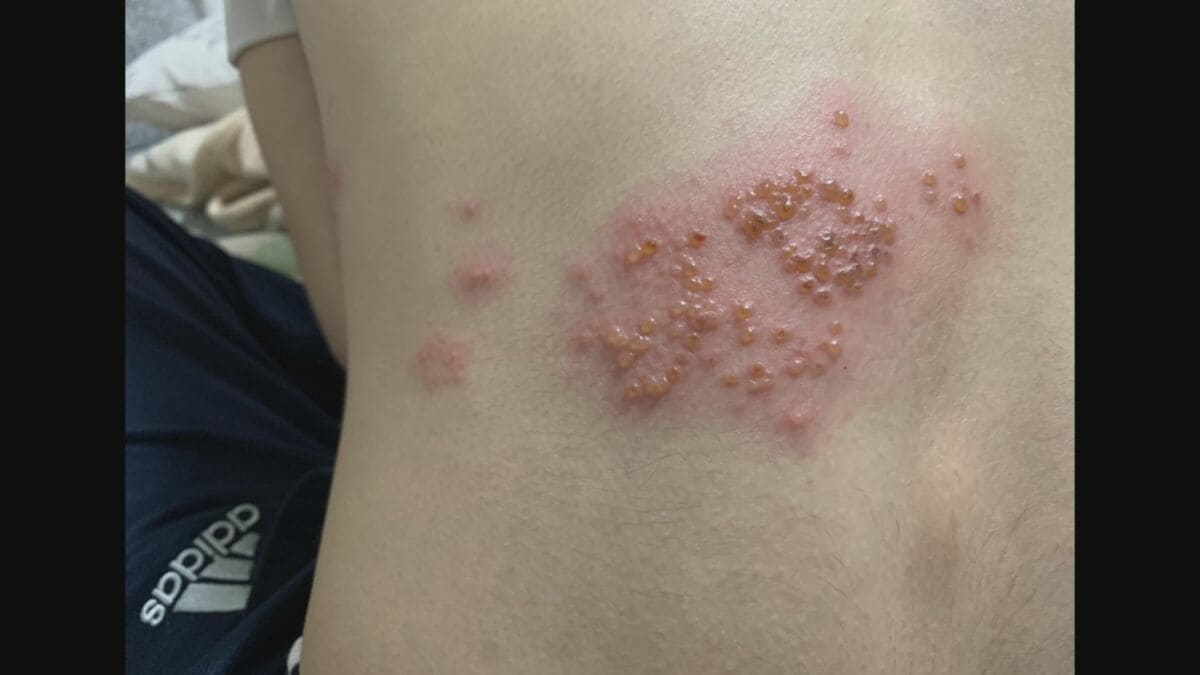 帯状 疱疹 お腹