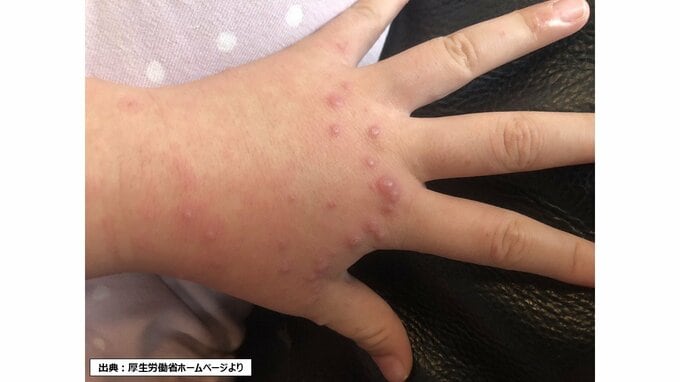 新潟県で手足口病がさらに増加　1週間で347人と前週の約1.6倍　警報レベルの流行続く|TBS NEWS DIG