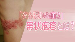 「帯状疱疹」20代～40代で急増での理由　顔面神経麻痺、視力障害のリスクも…　重要なのは「初期症状」|TBS NEWS DIG
