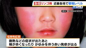 【感染拡大】リンゴ病が近畿各地で「警報レベル」飛まつ感染や接触で感染 妊娠中に感染すると合併症や流産の危険も|TBS NEWS DIG